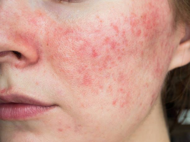 Top Rosacea Triggers and How to Avoid them
